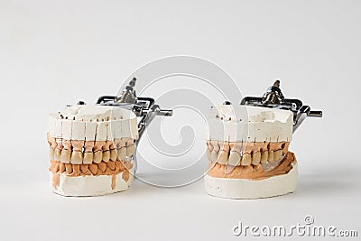 Gypsum Dentures with porcelain teeth isolated on white background Stock Photo