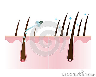 Hair density treatment vector illustration isolated on white background. Cartoon Illustration