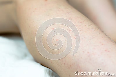 Hair on female legs. Ingrown hair problem. Hairy female legs Stock Photo