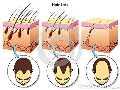 Hair loss Vector Illustration