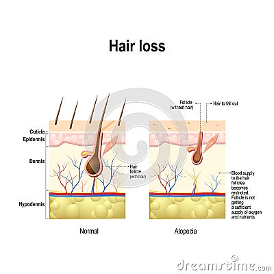 Hair loss, alopecia, baldness Vector Illustration