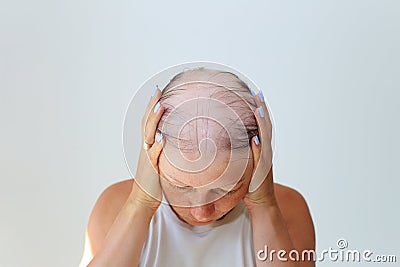 Hair loss in the form of alopecia areata. Stock Photo