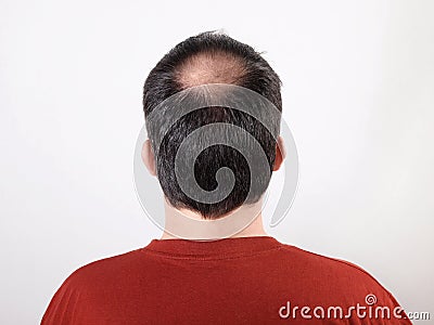 Hair loss Stock Photo