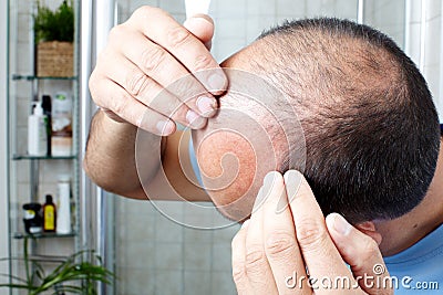 Hair loss. Stock Photo