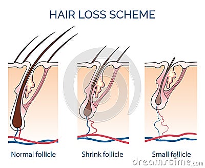 Hair loss scheme Vector Illustration