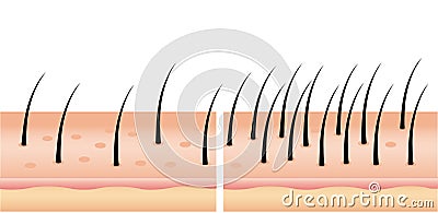 Hair loss stages set of before and after steps. Side view of a man losing hair before and after hair treatment and transplantation Stock Photo