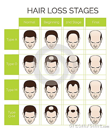 Hair loss stages and types for men Vector Illustration