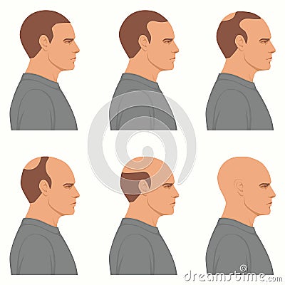 Hair loss stages vector isolated. Male alopecia. Set of balding process. Hairless man heads side view. Vector Illustration