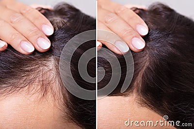 Before And After Hair Loss Treatment Stock Photo