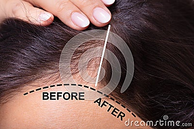 Before And After Hair Loss Treatment Stock Photo