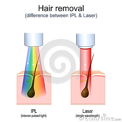 hair removal. Laser vs Intense Pulsed Light (IPL Vector Illustration