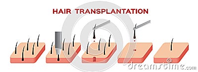 Hair transplant Vector Illustration