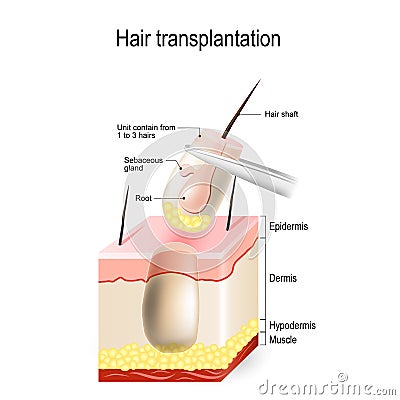 Hair transplantation Vector Illustration