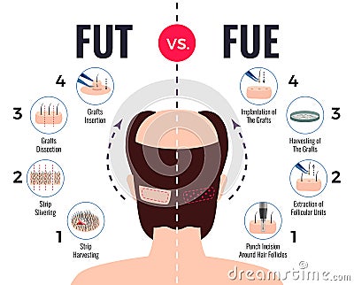 Hair Transplantation Fut Vs Fue Vector Illustration