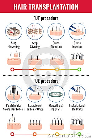 Hair Transplantation Infographics Vector Illustration