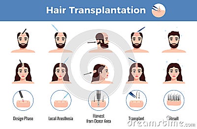 Hair Transplantation Men Women Infographics Vector Illustration