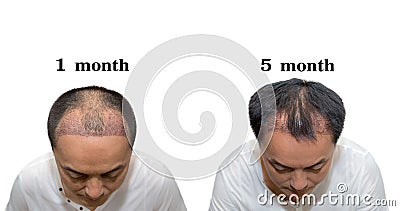 Hair transplantation surgery steps. Patient before and after the procedure Stock Photo