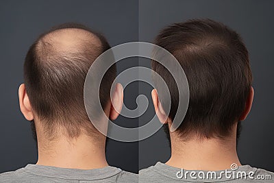 Hair treatment result before and after. Generative Ai Stock Photo