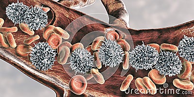 Hairy cell leukemia Cartoon Illustration