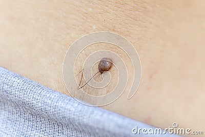 Hairy skin mole or melanoma of the skin of the back on a man`s body. Proliferation of pigment dermal cells. Dermatologist medical Stock Photo