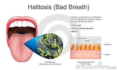 Halitosis bad breath. Education info graphic. Vector design. Stock Photo