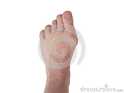 Hallux valgus deformation , legs, isolated white, patient aching joints Stock Photo