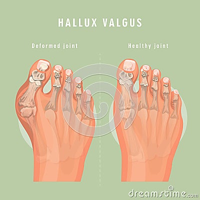 Hallux valgus vector medicine poster. Vector Illustration