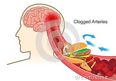 Hamburger and Pizza and French fries block red blood cell cause clogged in artery before into brain. Vector Illustration