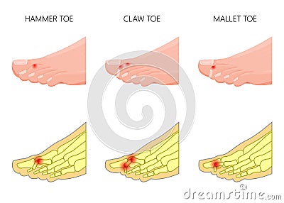 Hammer_claw_mallet_toe Vector Illustration