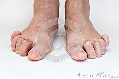 Hammer toe feet Stock Photo