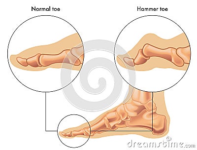 Hammer toe Vector Illustration