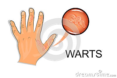 Hand affected by the wart Vector Illustration