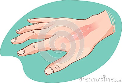 Hand burn Vector Illustration