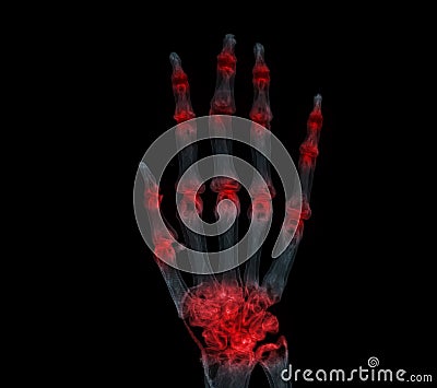 Hand 3D rendering for rheumatoid arthritis Concept Stock Photo