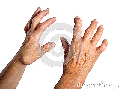 Hand Deformed From Rheumatoid Arthritis Stock Photo