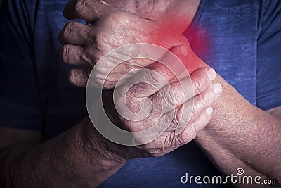 Hand Deformed From Rheumatoid Arthritis Stock Photo