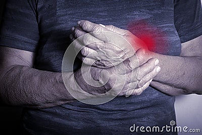 Hand Deformed From Rheumatoid Arthritis Stock Photo