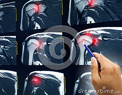 MRI of shoulder showing rotator cuff tendon tear Stock Photo