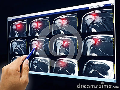 MRI of shoulder showing rotator cuff tendon tear Stock Photo