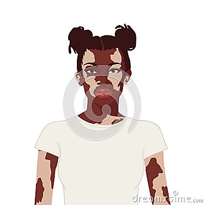 Flat realistic african woman with vitiligo on white background Vector Illustration