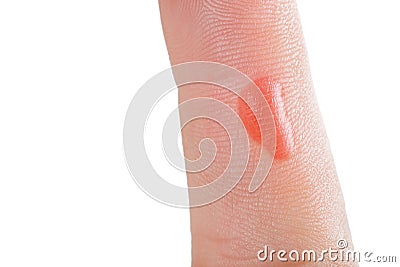 On hand finger there is red blister. Stock Photo