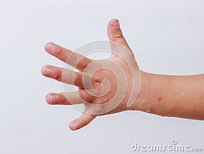 Hand-foot-and-mouth disease HFMD human hand of scarlet fever on palm enterovirus Stock Photo