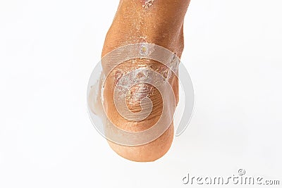 Hand Foot Mouth Syndrome. Royalty-Free Stock Photo | CartoonDealer.com