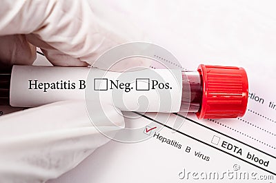 Hand holding Blood tube for hepatitis testing. Stock Photo