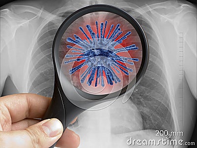 Hand holding magnifying glass focusing on virus cell on lung chest xray Stock Photo