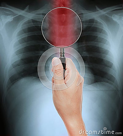 Hand holding Magnifying glass on X-ray of a human thorax with esophagus highlighted in red Stock Photo