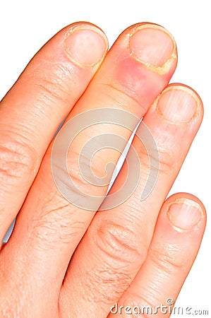 Hand infection Stock Photo
