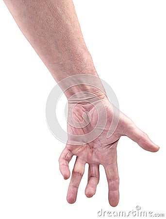 Hand of an man with Dupuytren contracture disease Stock Photo