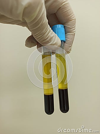 A hand in a glove holds vacuettes with blood to determine hemostasis. Stock Photo