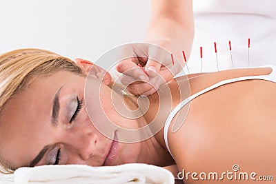 Hand Performing Acupuncture Therapy On Customer's Back Stock Photo